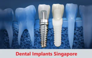 Dental-Implants-Singapore