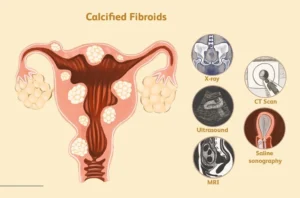 Calcified-Uterine-Fibroids-Singapore