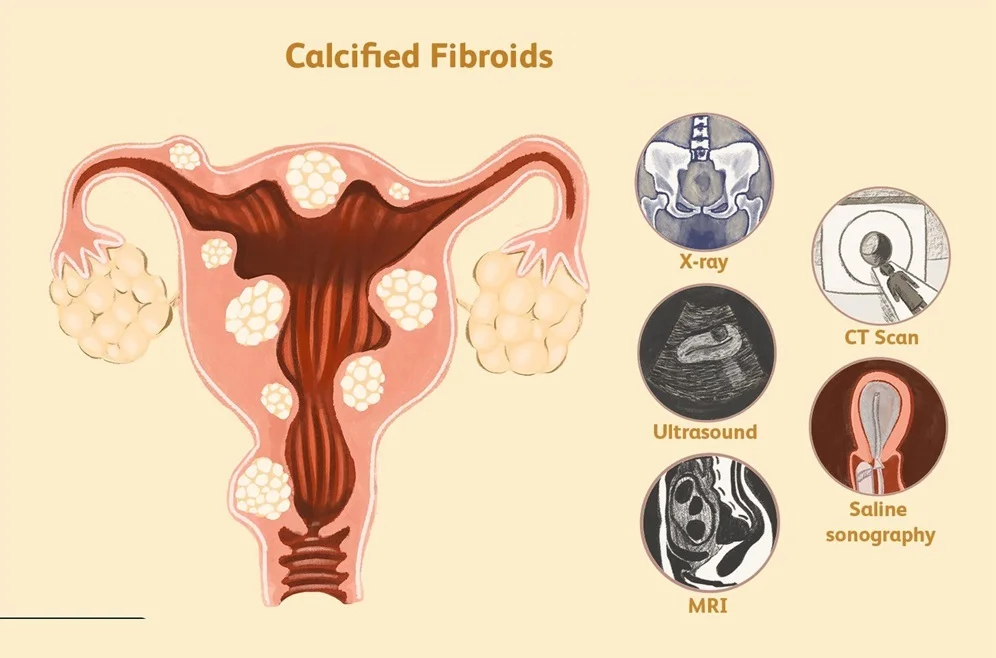 Calcified-Uterine-Fibroids-Singapore