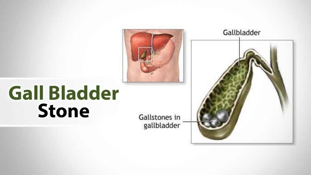 Gallstone-Removal