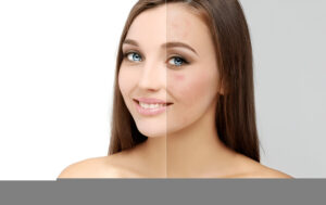 Pigmentation-Removal-Singapore