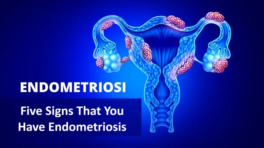 Endometriosis